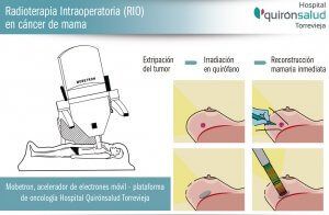 Tratamiento de cáncer de mama.