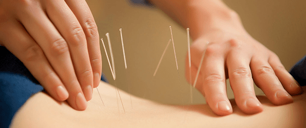 acupuntura