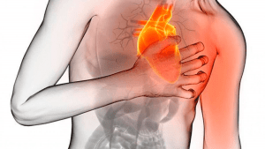  infarto agudo de miocardio