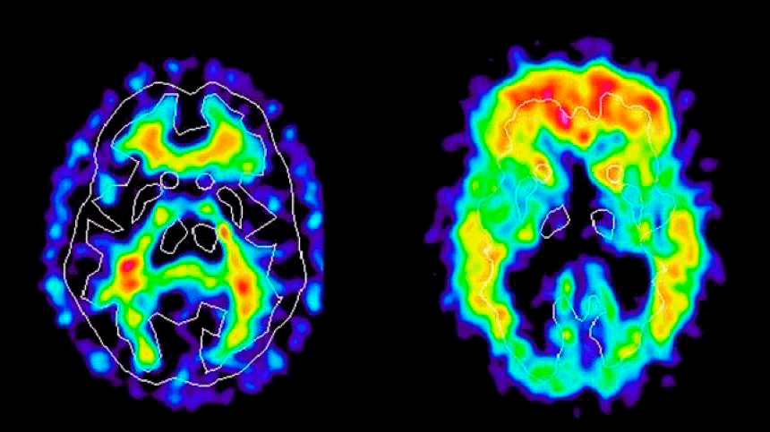 Radiología en el cerebro.