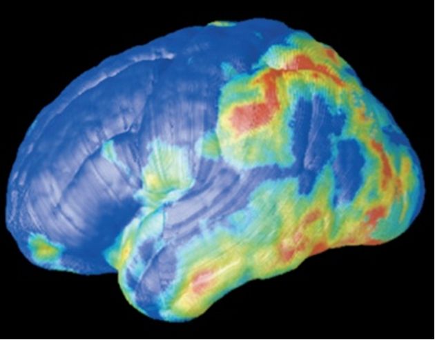 Proteína TAU en el cerebro