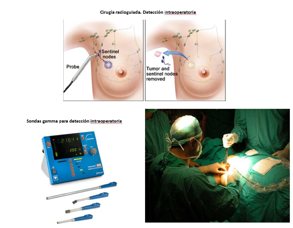 sonda gamma intraoperatoria