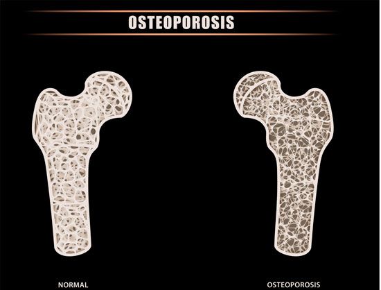 osteoporosis