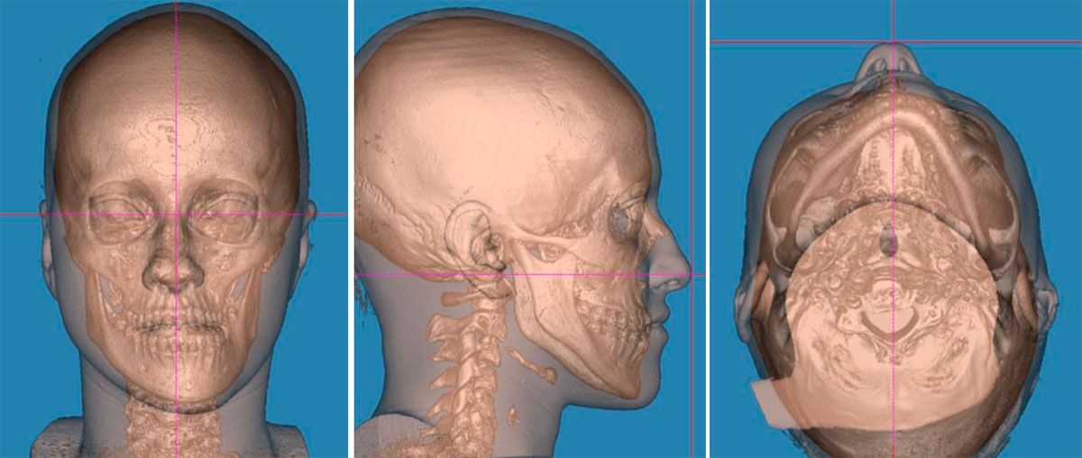 estudio-3d-asimetría-facial