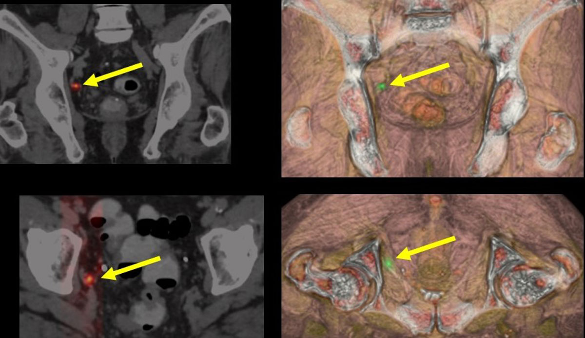 recidiva-ganglionar-del-cáncer-de-próstata