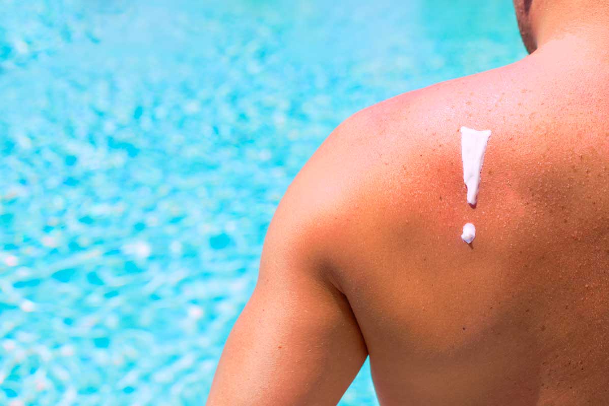 como-evitar-el-melanoma-en-verano