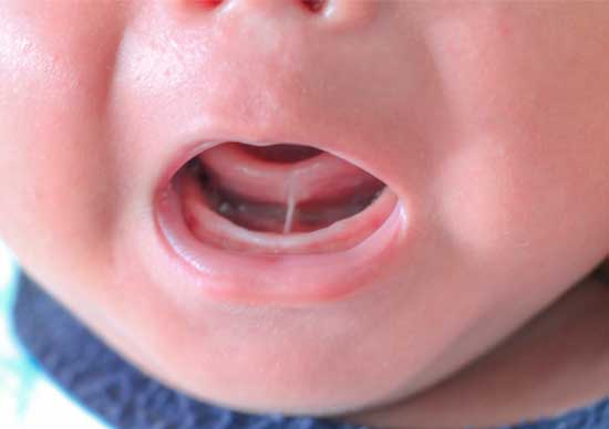 frenillo-lengua-bebé