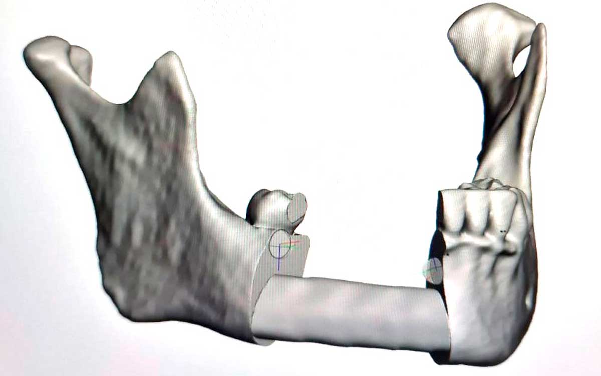 reconstruccion-mandibular-con-perone