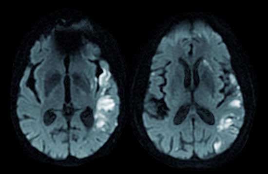 Cardiopatías,-trombos-e-ictus