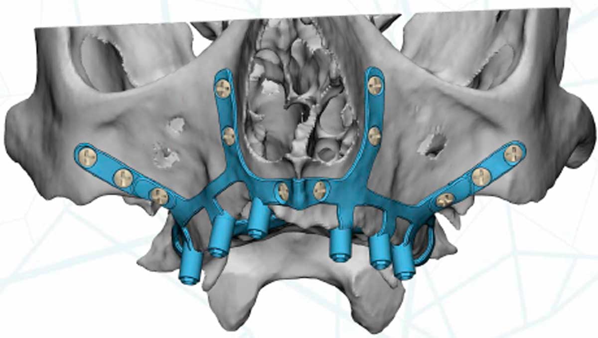 Diseño-estructura-subperióstica