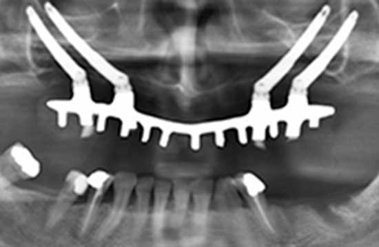 innovación-en-la-implantología-dental