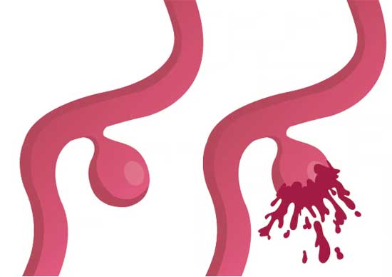 Aneurismas: causas, complicaciones y abordaje de esta enfermedad arterial