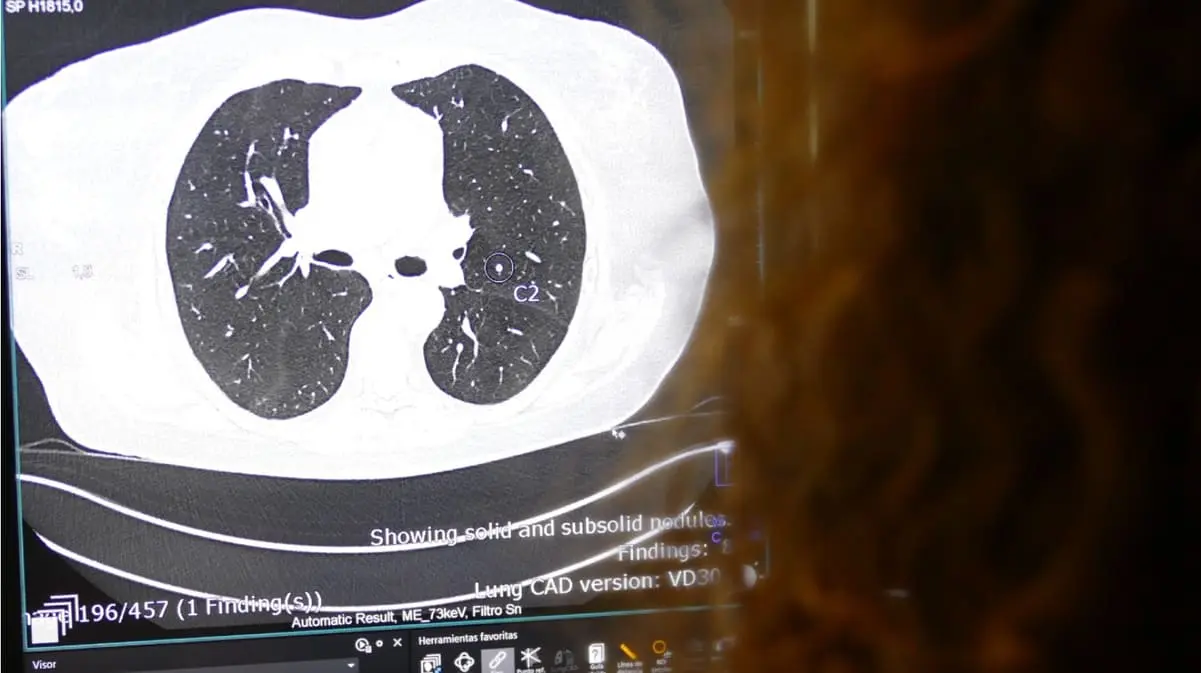 TAC-IA-nódulo-pulmonar-Hospital-Quirónsalud-Madrid