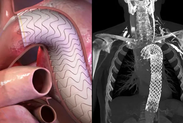 cirugía aneurisma aorta torácica con endoprótesis flexibles