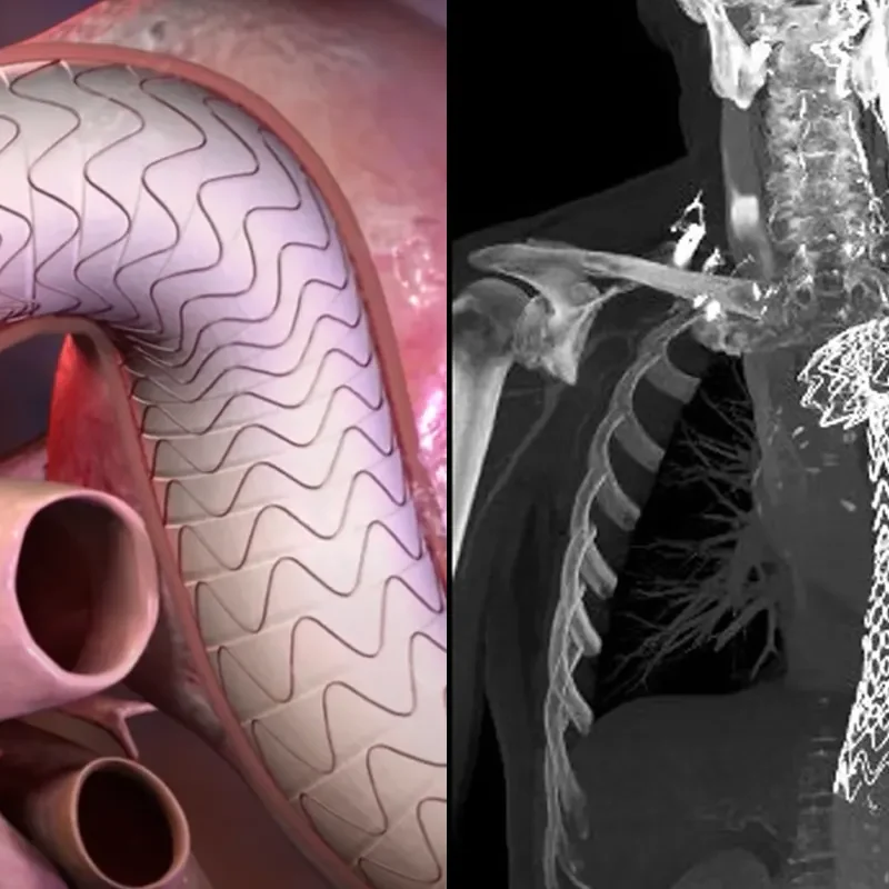 cirugía aneurisma aorta torácica con endoprótesis flexibles