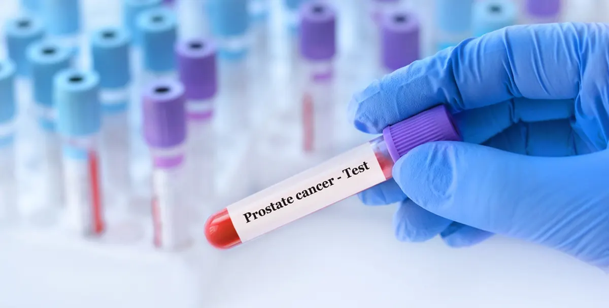 Un síntoma de cáncer de próstata metastásico y una necesaria redefinición en las estrategias de prevención