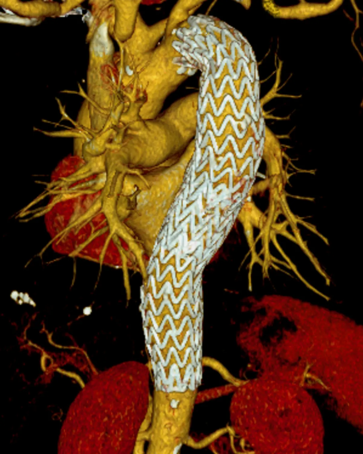 endoprótesis flexibles aorta torácica