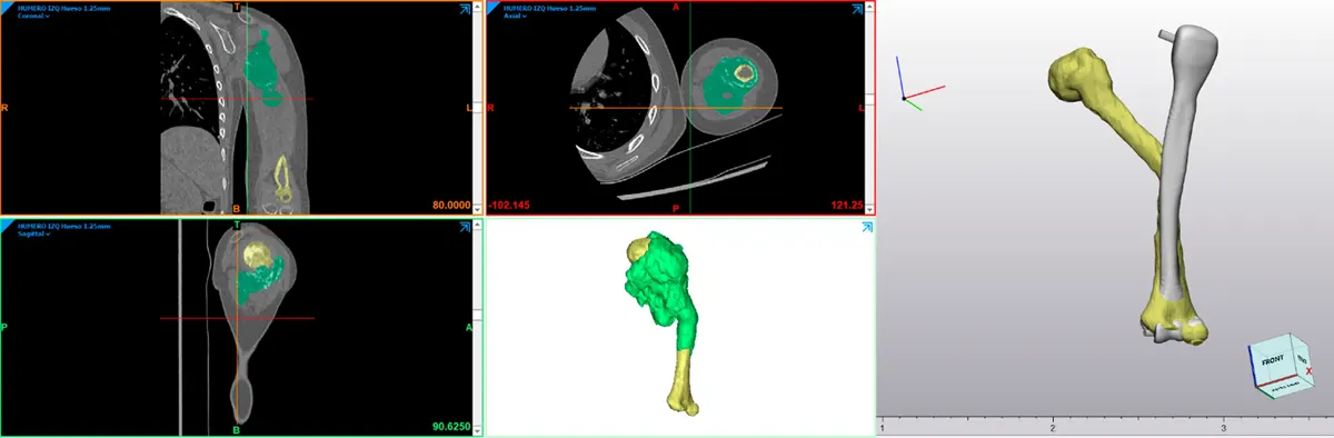 Imagen médica original del paciente (TC), segmentación de estructuras anatómicas y tumorales húmero y osteosarcoma