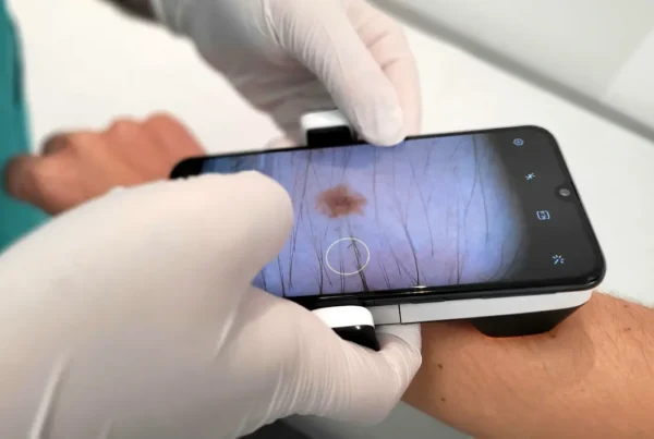 Dermatoscopio-Teledermatología