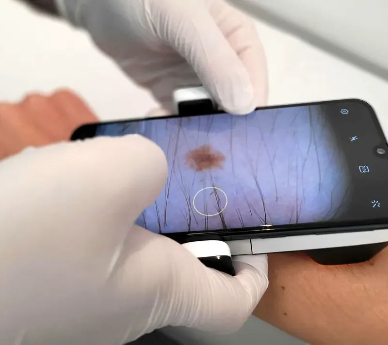 Dermatoscopio-Teledermatología