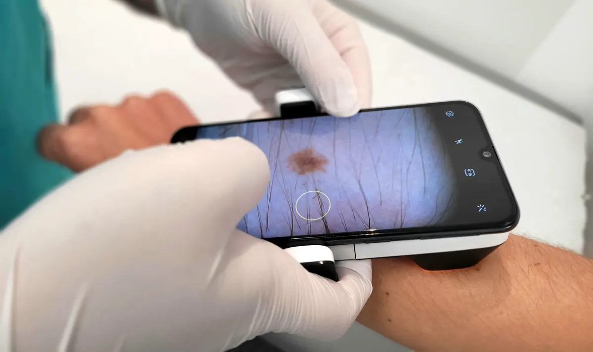 La importancia de revisar la piel tras el verano y la comodidad que proporciona la teledermatología