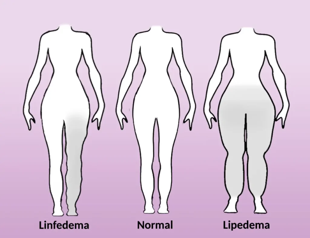 lipedema y el linfedema