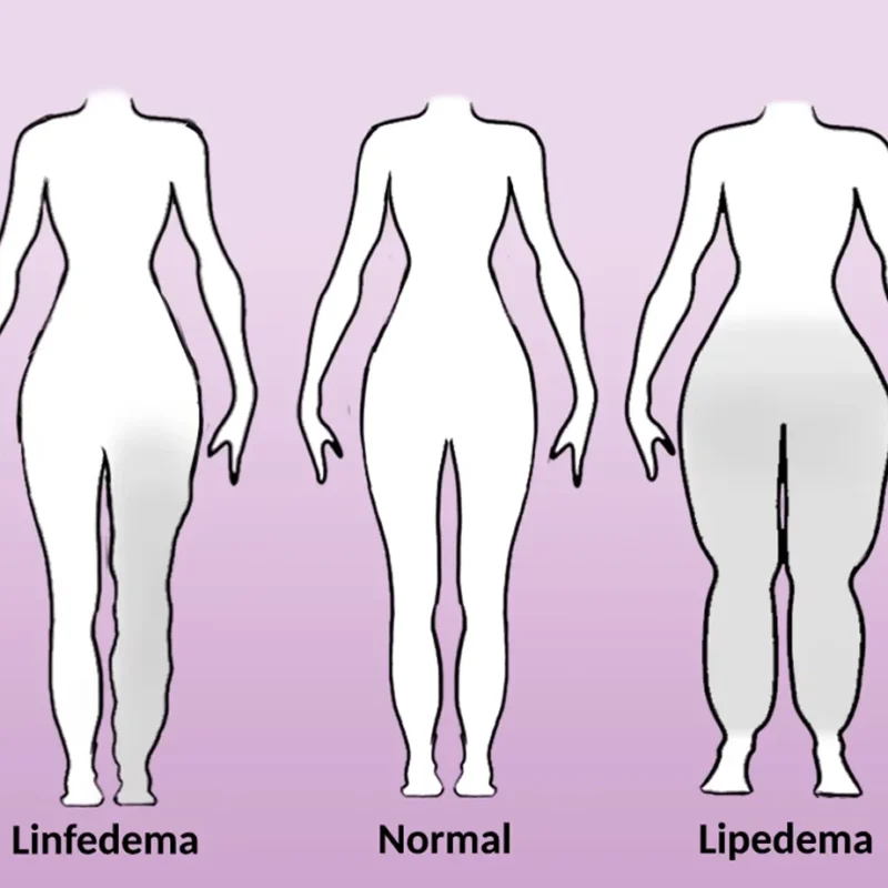 lipedema y el linfedema