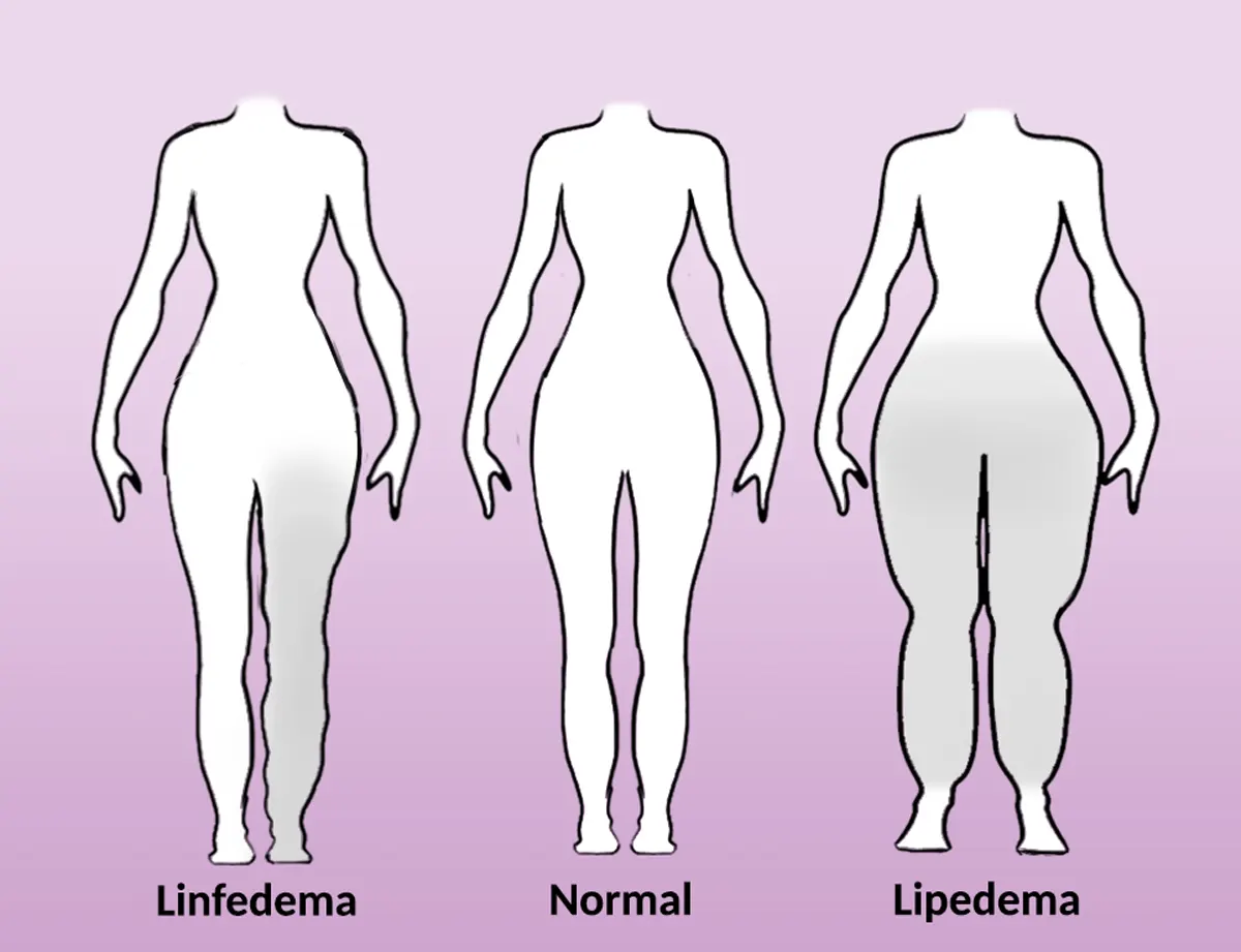 Claves para diferenciar el lipedema y el linfedema