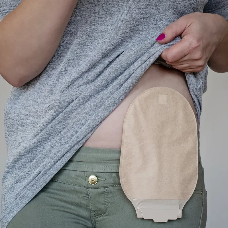 paciente con ostomía