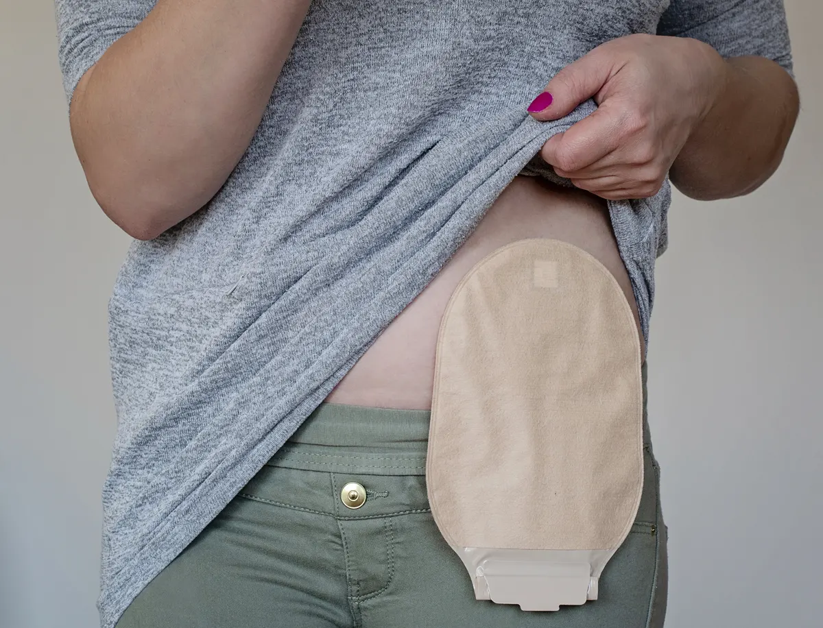 El Hospital Universitario La Luz dedica una jornada a los pacientes con ostomía