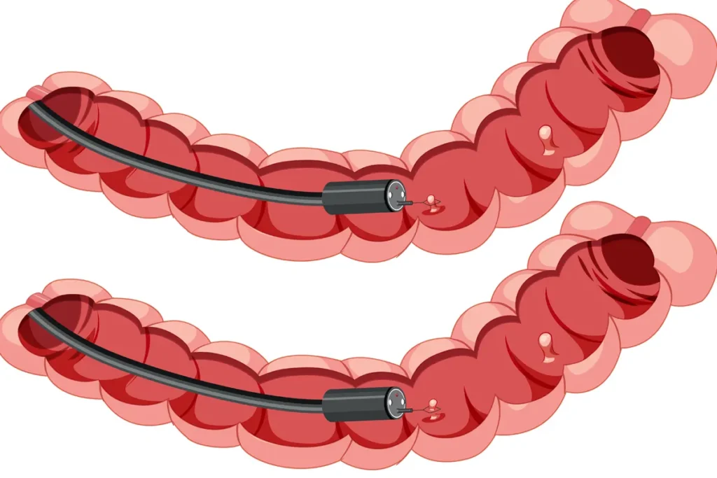 colonoscopia cribado cáncer colorrectal