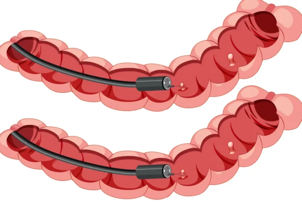 colonoscopia cribado cáncer colorrectal