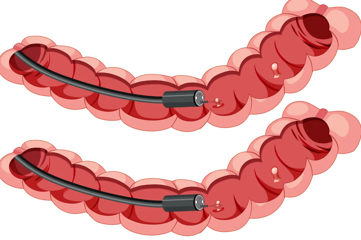La poderosa razón para participar en programas de cribados de cáncer colorrectal a partir de los 50 años