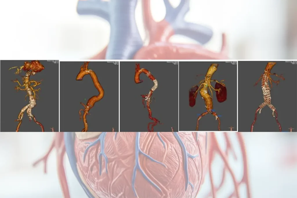 patologías de la aorta