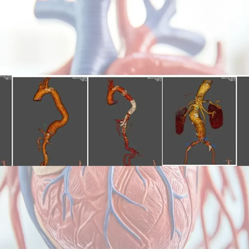 patologías de la aorta