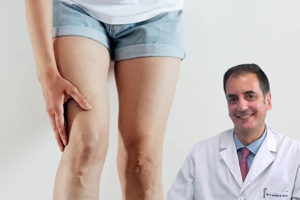 Cómo tratar las varices con la escleroterapia