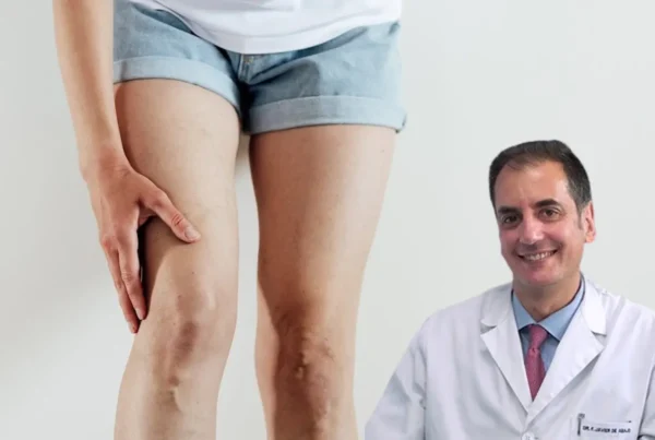 Cómo tratar las varices con la escleroterapia