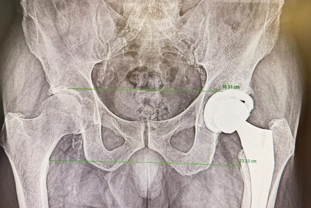cirugía de prótesis de cadera