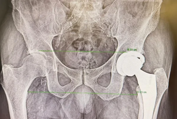 cirugía de prótesis de cadera