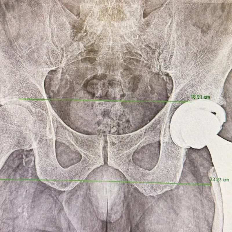 cirugía de prótesis de cadera
