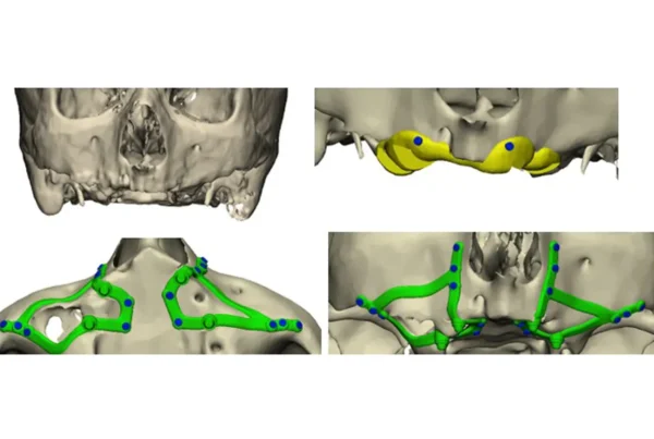 implantes subperiósticos para pacientes con maxilares severamente atróficos