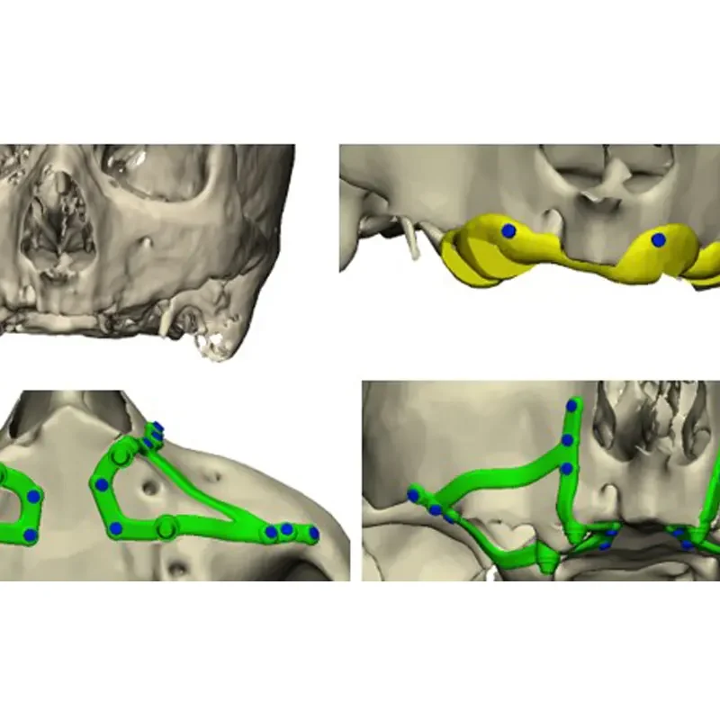 implantes subperiósticos para pacientes con maxilares severamente atróficos