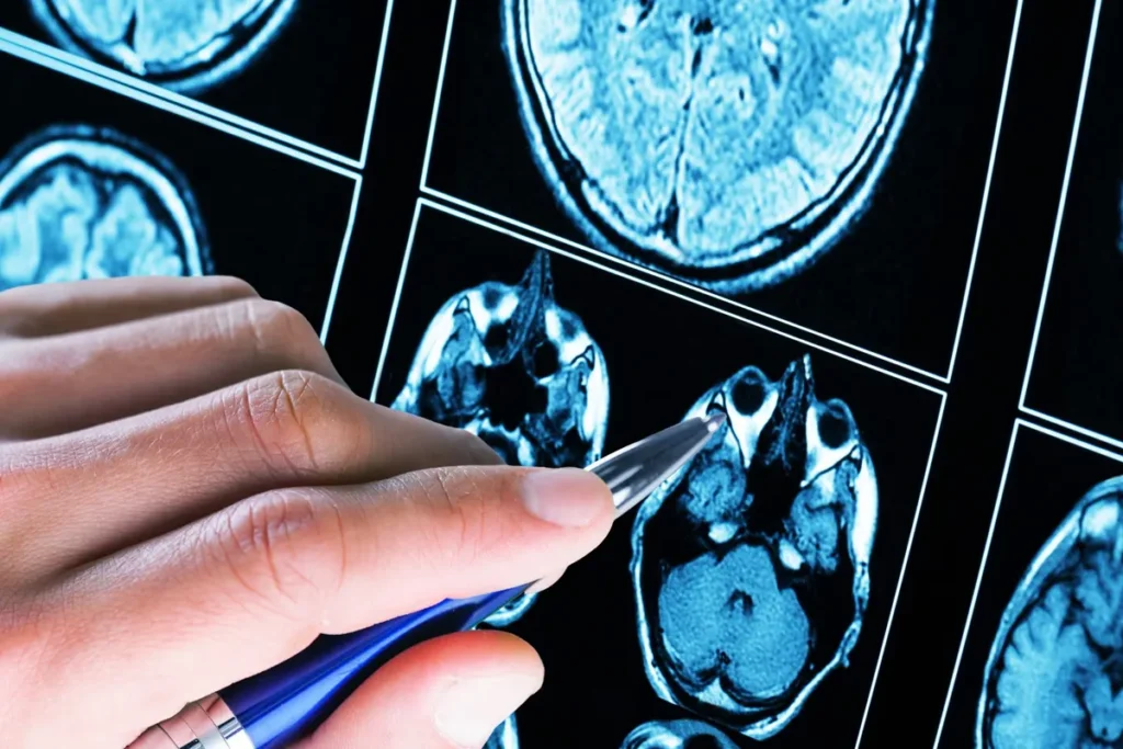 microcirugía tumores cerebrales