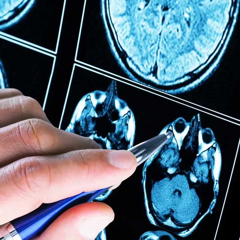 microcirugía tumores cerebrales