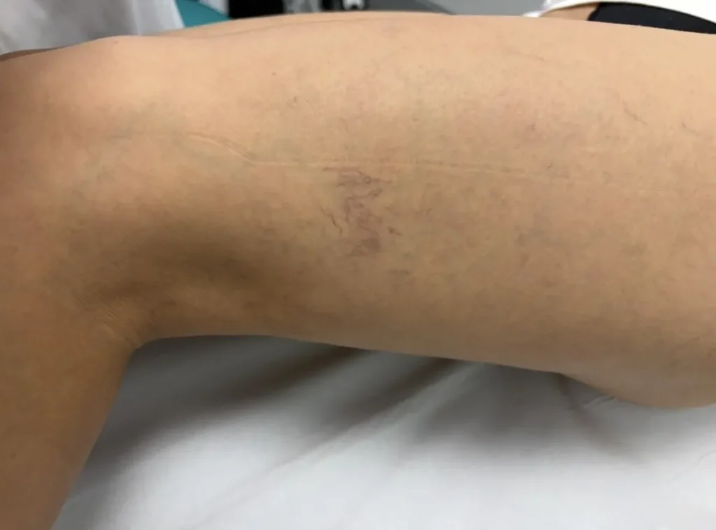 prevención de las varices