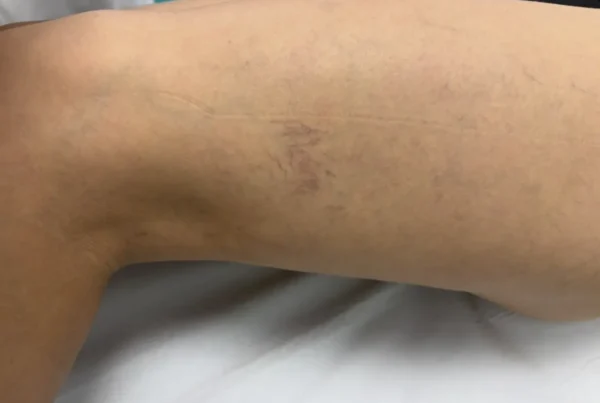 prevención de las varices