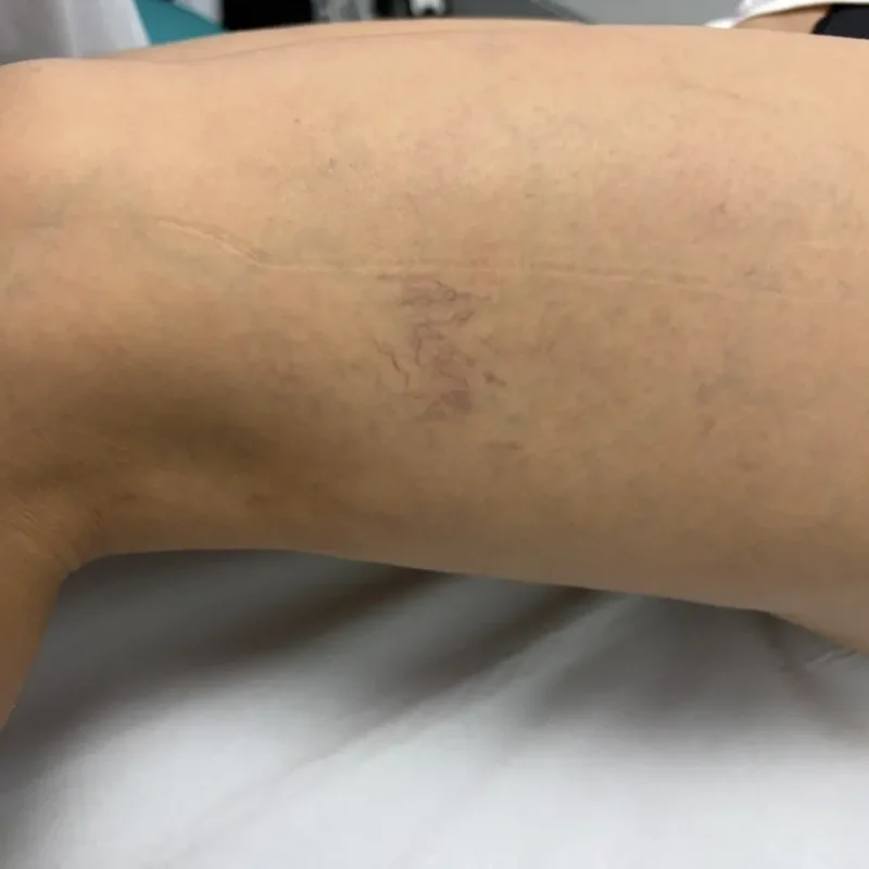 prevención de las varices