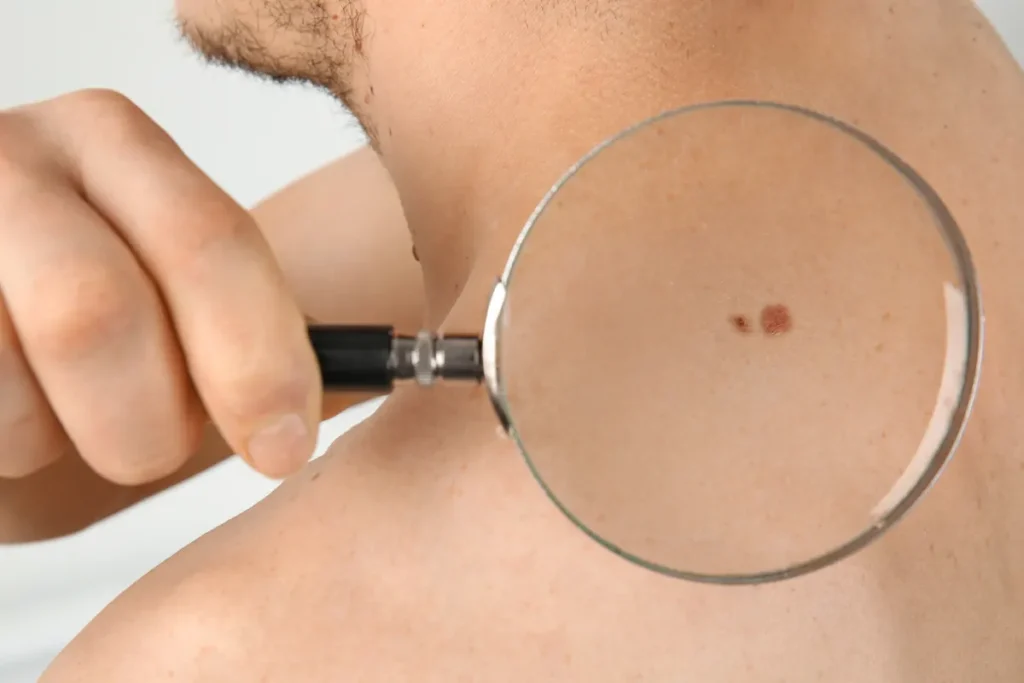 tipos de cáncer cutáneo