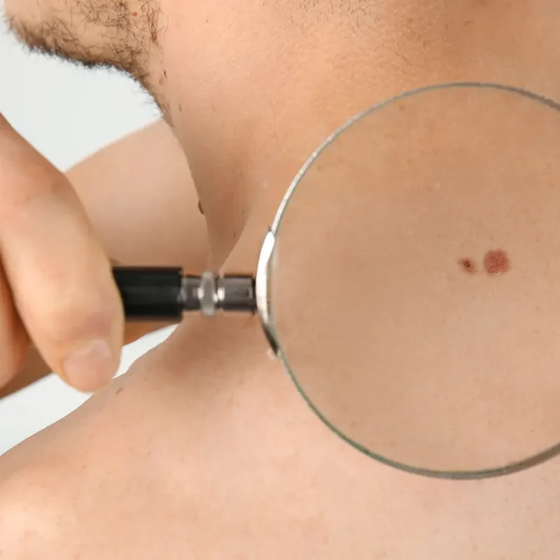 tipos de cáncer cutáneo