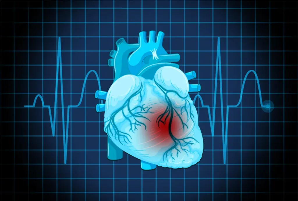 infarto y enfermedad cardiovascular